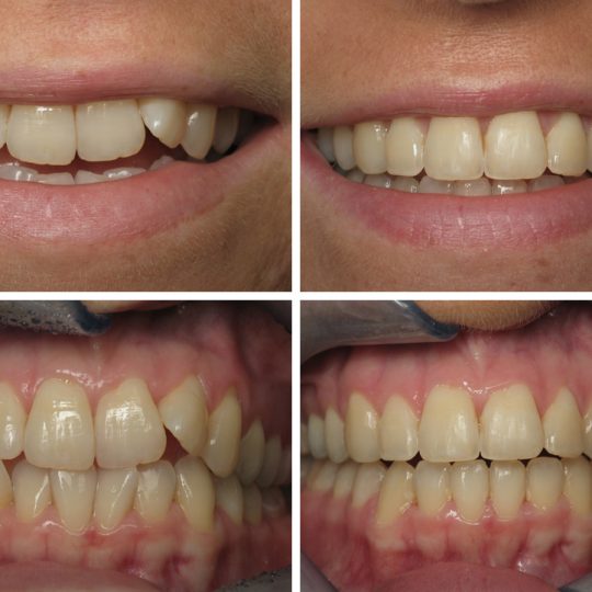 Teeth Before & After